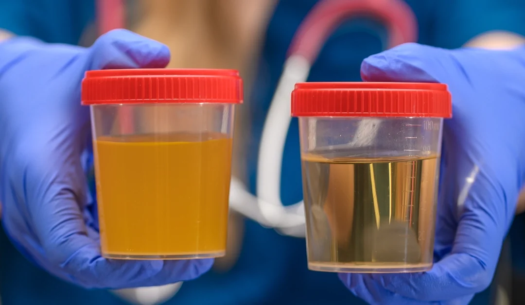 Cloudy Urine Causes: What It Means and When to Be Concerned